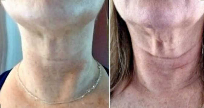 How I Tightened Saggy Skin At-Home. Pictures turkey neck after and before